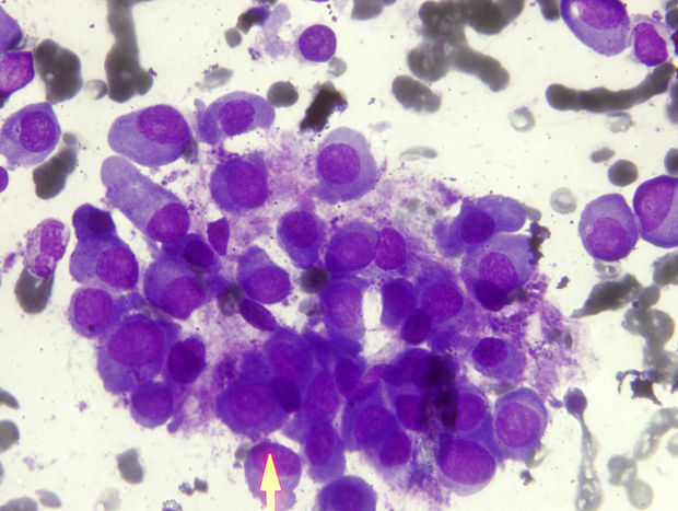 Studies met pembrolizumab bij multipel myeloom opgeschort