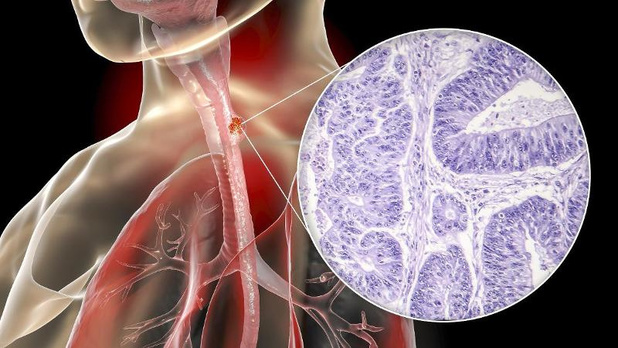 Toevoeging panitumumab aan cisplatine-fluorouracil verhoogt enkel nevenwerkingen