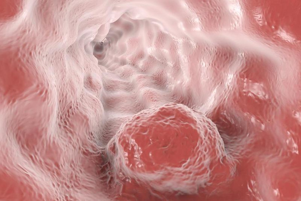 Toevoeging cetuximab aan radiochemotherapie verbetert de resultaten